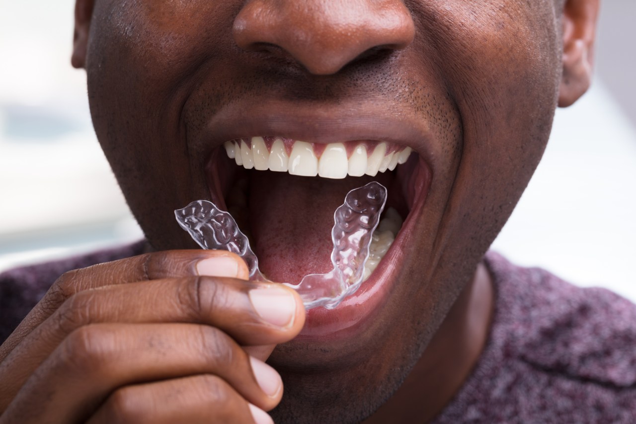 10 Clear Aligner Facts From an Orthodontist Dental Arts NOLA