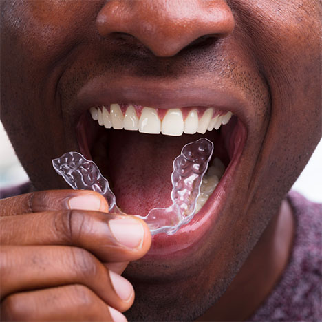 Clear Aligners Algiers LA